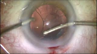 Implantation of the FINEVISION IOL POD F [upl. by Sadnak311]