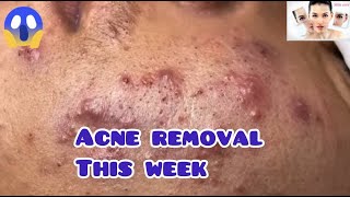 Cystic Acne extraction This Week  Blackheads removal 42 [upl. by Cockburn]