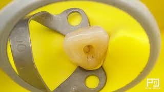 ROOT CANAL TREATMENT 22 IRREVERSIBLE PULPITIS  DR PACO CASTANEDA [upl. by Roch941]