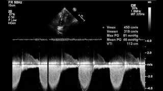 Valvular pulmonary stenosis [upl. by Nos]