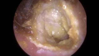 194 Eardrum about to EXPLODE after Blocked Ear Wax Removal using Endoscopic Ear Microsuction [upl. by Adda107]