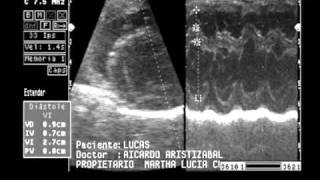 insuficiencia valvular mitral y tricuspideawmv [upl. by Marino]