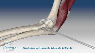 Ricostruzione del Legamento Collaterale Laterale del Gomito con NOVALIG® [upl. by Yci]