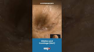 बच्चेदानी Uterus का Dilation और Curettage  Procedure for removing unwanted tissue in uterus [upl. by Eberhard]