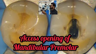 Access opening of Mandibular Premolar step by step demonstration rct for beginners dental lectures [upl. by Remoh812]