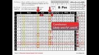 Antibody ID Basic Cases Part 2 [upl. by Nurav]