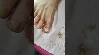 Deep Toenail Removal [upl. by Lulita]