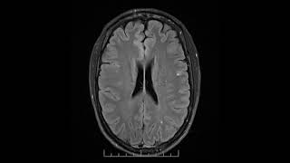 MRI showing progressive multifocal leukoencephalopathy [upl. by Lenroc]