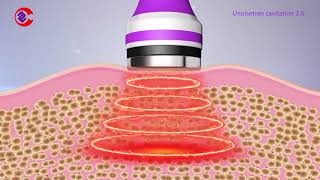 How Ultrasonic Cavitation Work How Ultrasonic Cavitation Remove Fat What Is Cavitation Machine [upl. by Bertie]