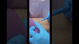 Skin Tag Removal Shave Excision in London ON [upl. by Talya]