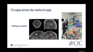 Dr Eduardo Lovo  Radiocirugía preoperatoria en Metástasis a Cerebro  CIC [upl. by Solracsiul]