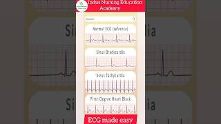 ECG Made Easy ecg mbbs neet ecginterpretation nursing youtubeshorts viral trending shorts [upl. by Anerehs]