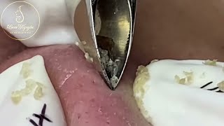 Nose Zone Precision Blackhead Extraction [upl. by Llerud]