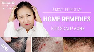 How to Get Rid of Scalp amp Back of Neck Acne Naturally  3 Most Effective Home Remedies [upl. by Nwaf]