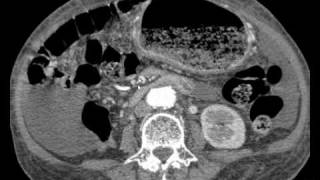 CT interpretation  stomach cancer with cacinomatosis peritonei and omental cake [upl. by Jowett]