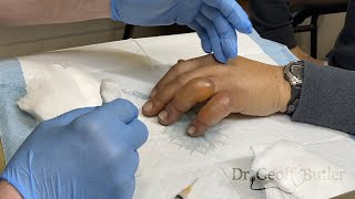 Drainage of blisters secondary to frostbite [upl. by Aivan]