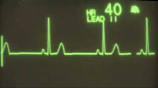 Sinus Bradycardia  ECG Training [upl. by Anelrac]