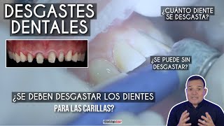 ¿Se deben desgastar los dientes para las carillas 🤔 ¿Se hace en todos los casos Odontología Láser [upl. by Horlacher]