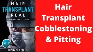 Hair transplant cobblestoning pitting and rimming [upl. by Mag]