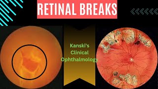 Retinal breaksKanskis clinical ophthalmology retinal tear retinal detachment subretinal fluid [upl. by Saxena]