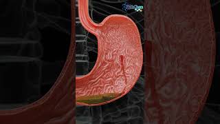 Understanding Hemorrhagic Gastric Ulcers [upl. by Omsoc133]