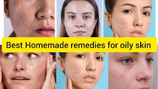 Tips for Oily skin Homemade remedies for Oily skin [upl. by Ennairod63]