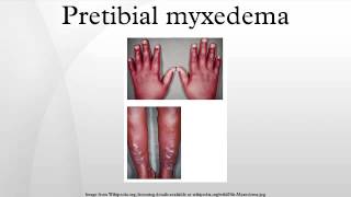 Pretibial myxedema [upl. by Luht]