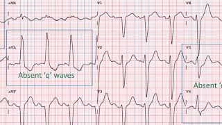 How to identify Left Bundle Branch Block in an ECG [upl. by Airdnala545]