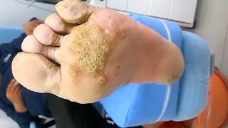 Remove severe massive plantar warts  Satisfying amp Relaxing Video38 [upl. by Letrice]