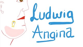 Ludwig Angina  🚑  Causes Clinical Picture Diagnosis and Management [upl. by Naitsabes]