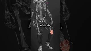 Joint Pain Discover the Main Causes of Arthritis [upl. by Trueblood]