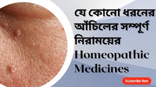 WARTS  আঁচিল এর সম্পূর্ণ নিরাময়ের জন্য HOMEOPATHIC MEDICINES [upl. by Herodias]