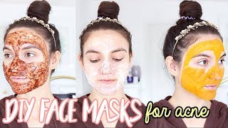 4 DIY Face Masks For ACNE  How To Get Rid Of Pimples OVERNIGHT [upl. by Theodore651]