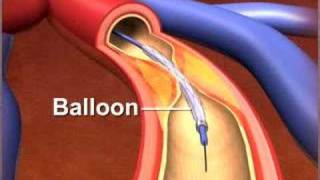 Percutaneous coronary Intervention stenting [upl. by Bradway]