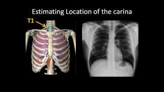 Basic Chest Radiology ET Tube Position and Complications [upl. by Lonergan]