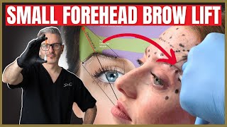 How To Perform a Botox Brow lift on a small forehead [upl. by Erdnad76]