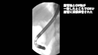 ERCP関連手技：Wireguided cannulation [upl. by Fred]