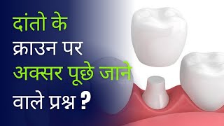 दांतो के क्राउन पर अक्सर पूछे जाने वाले प्रश्न   Faqs on Crowns [upl. by Ydna]