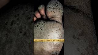 Pitted keratolysis 🔥 skincare bacterialinfection footcare [upl. by Dutchman]