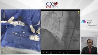 PCI of Calcific Nodules of RCA using Stepped Burr RotaTripsy  March 2024 [upl. by Caia470]