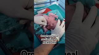 suctioning in new born pediatrics LSCS BABY FIRST CRY [upl. by Essined]