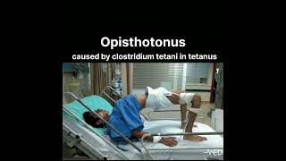 Opisthotonus caused by clostridium tetani in tetanusdoctorviral viralvideo ankylosingspondylitis [upl. by Adnirb]