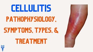 CELLULITIS Pathophysiology Types Treatment Symptoms amp Nursing Interventions [upl. by Towroy]