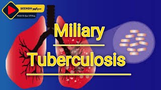 Miliary tuberculosis  Miliary Tb Couses  Sign Symptoms and treatment in Hindi  Urdu By Dr ijaz [upl. by Esiom]