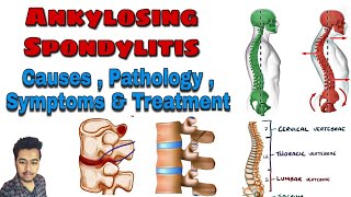 Ankylosing Spondylitis  Cause  Pathology  Symptoms  Treatment Nursing Lecture in Hindi MSN 1 [upl. by Boutis]