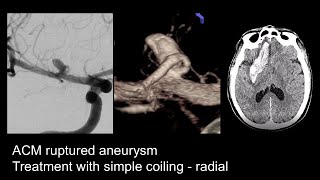 Ruptured Aneurysm Right MCA  Coiling  Radial [upl. by Mclyman762]