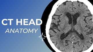 CT head anatomy for Medical students  residents and clinicians [upl. by Stearne748]