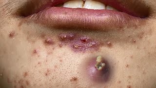 Big Cystic Acne Blackheads Extraction Blackheads amp Milia Whiteheads Removal Pimple Popping  9266 [upl. by Manoop]