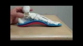 Metatarsalgia  Foot Orthotics [upl. by Gizela67]