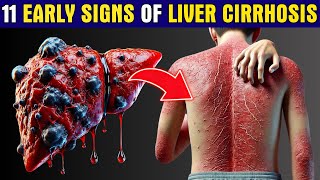 LIVER is DYING 11 Early Warning Signs of Liver Cirrhosis You Cant Ignore  Healthy Care [upl. by Nadoj414]